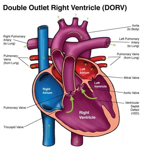 ventricular to pulmonary conduit types